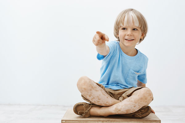 Enfant atteint de vitiligo